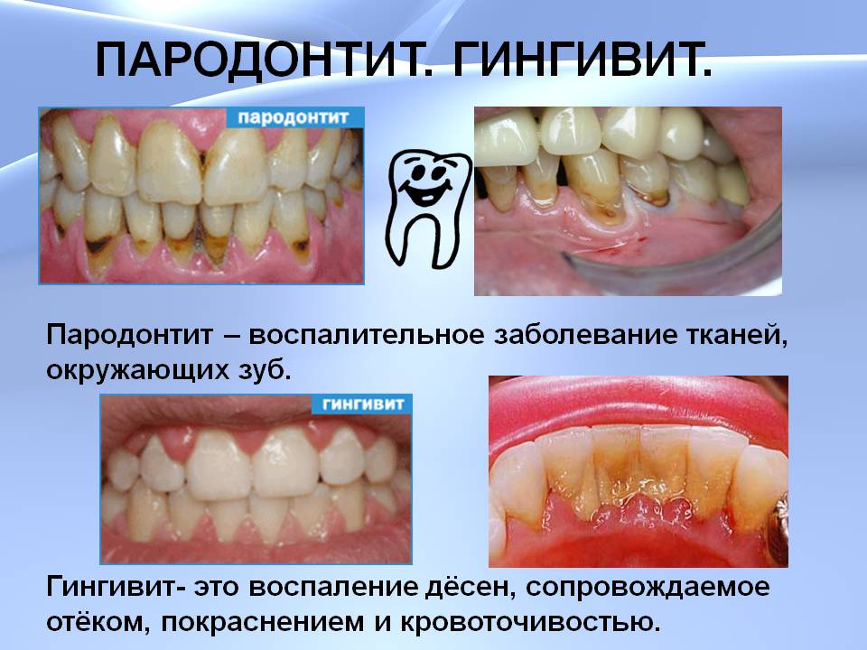 http://zubzubov.ru/wp-content/uploads/2013/08/parodontit-giginvit.jpg