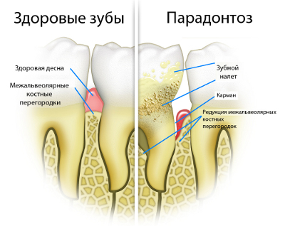 Как лечить цистит