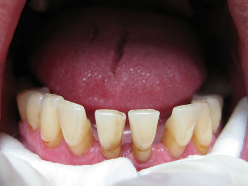 шинирование зубов