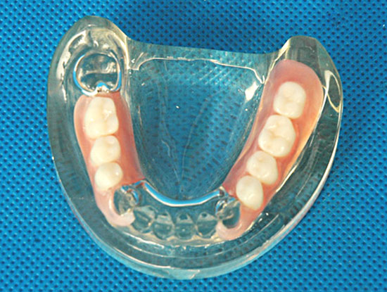 Недостатки нейлоновых зубных протезов