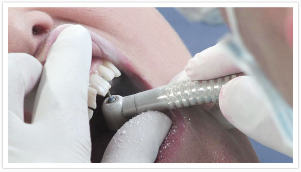 обтачивание зуба под коронку