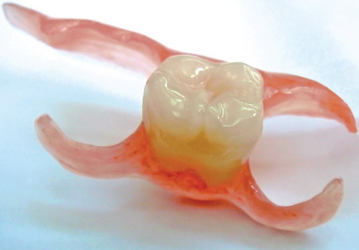 Нейлоновый протез на один зуб