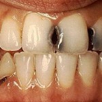 кариес между передними зубами