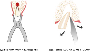 процесс удаления корня зуба