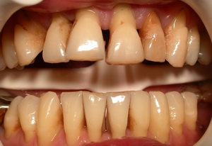 дёсны отходят от зубов лечение
