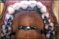 шинирование зубов отзывы пациентов